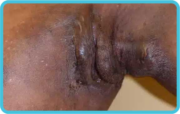 Introduction to Hidradenitis Suppurativa (Coming Soon)